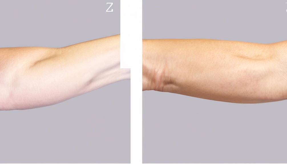 thermage for sagging arms